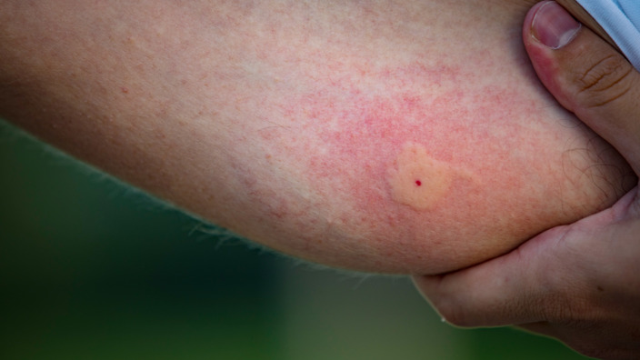 Geröteter, entzündeter Mückenstich auf der Haut