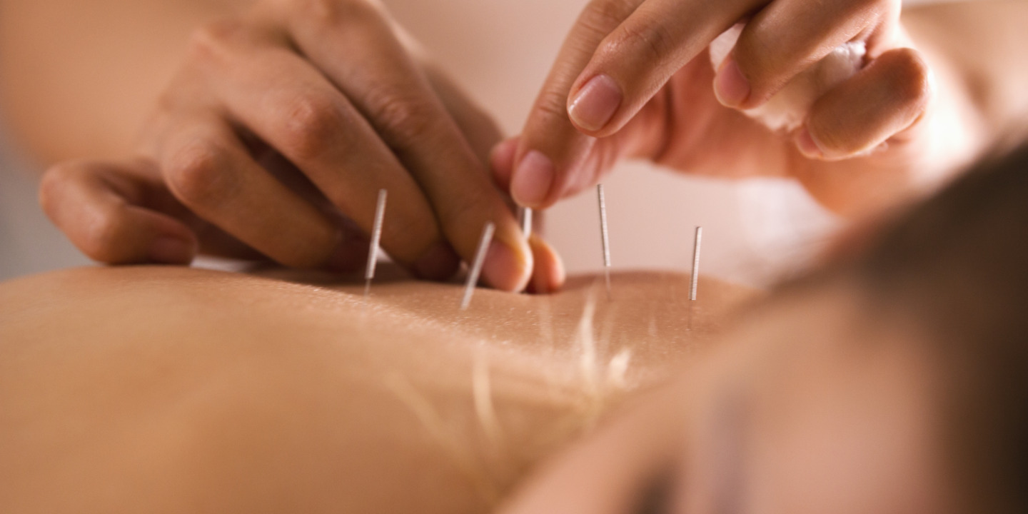 Rücken einer Frau wird mit Akupunktur behandelt.