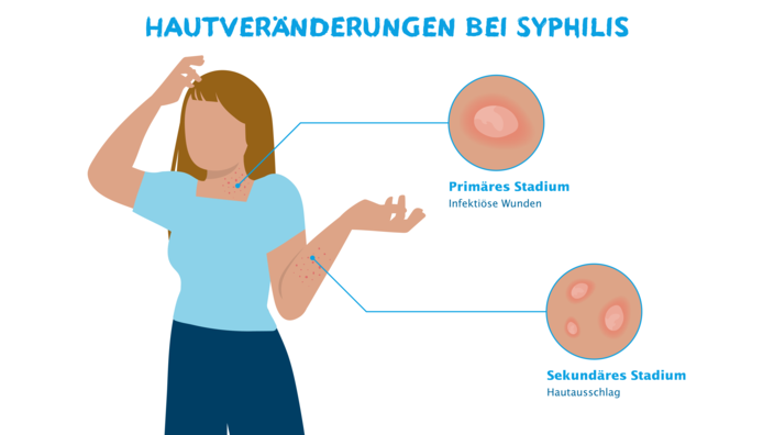 Infografik zur Hautveränderung bei Syphilis