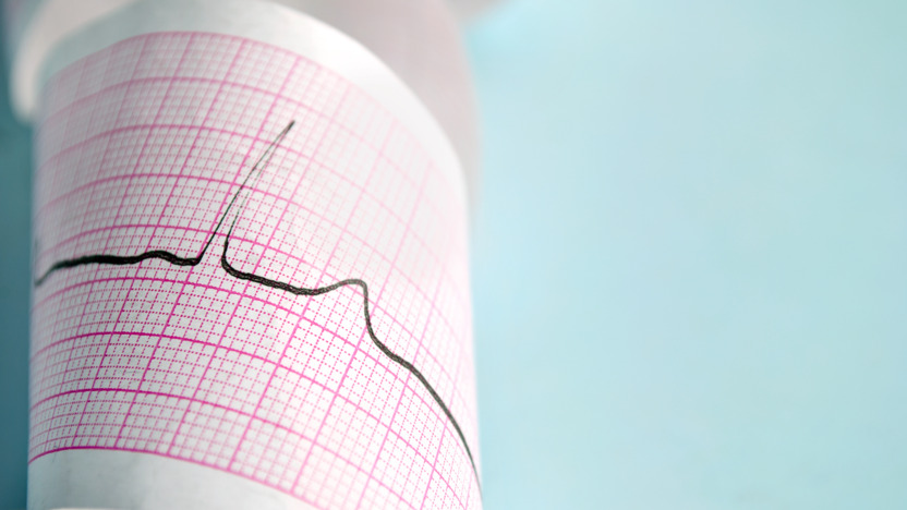 Der Ausdruck eines Elektrokardiogramm (EKG) auf Millimeterpapier