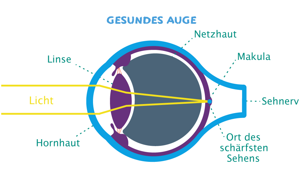 Das gesunde Auge: Das Bild trifft punktgenau auf die Netzhaut.